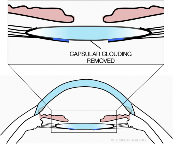 8. capsular clouding removed