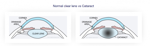 normal clear lens vs cataract2