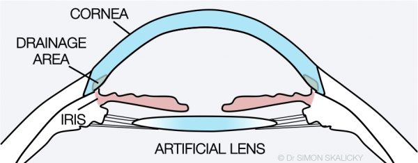 3. artificial lens inserted following cataract surgery