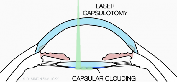 8. laser capsulotomy